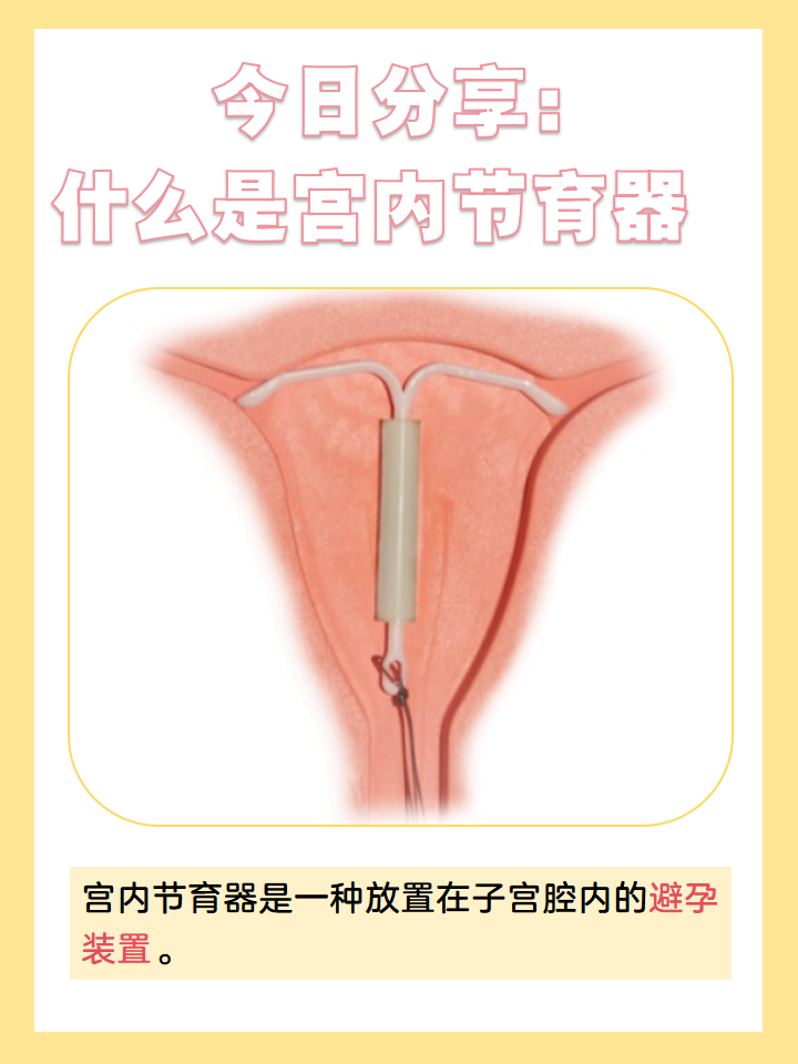 节育环有几种类型哪种最好图片